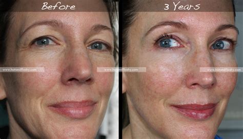 Retin-A for Wrinkles | 3-Year Results | Before & After – hotandflashy.com