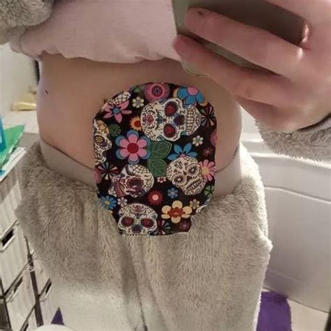 This young Crohn's patient has turned her surgical bag into a fashion accessory - Wales Online