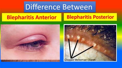 Difference Between Blepharitis Anterior and Blepharitis Posterior - YouTube