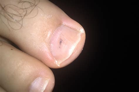 Melanoma under toenail pictures: black spot, nail melanoma pictures, toenail melanoma pictures ...
