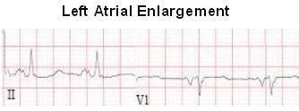 Left Atrial Enlargement (LAE) ECG Review - Criteria and Examples | LearntheHeart.com