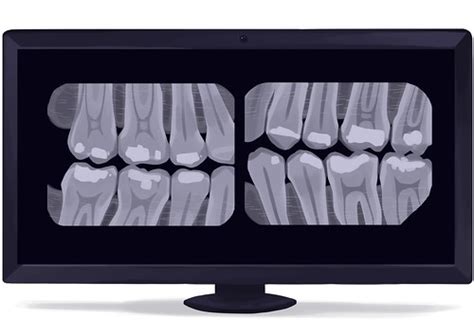 Bitewing dental x-ray digital technical picture | Picture by… | Flickr