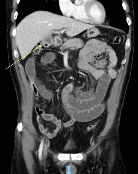 The site of the cholecystoduodenal fistula A small bowel obstruction... | Download Scientific ...