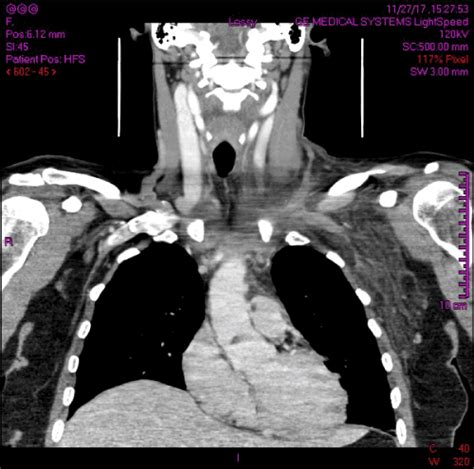 Primary, exercise induced internal jugular vein thrombosis – a case report