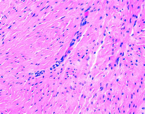 Plantar Fibromatosis (Ledderhose Disease) - Pathology - Orthobullets