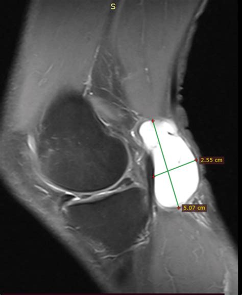 Cureus | Tibial Nerve Palsy: An Atypical Presentation of a Popliteal Cyst