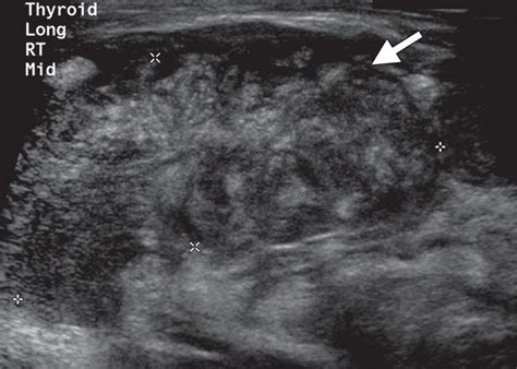 The Thyroid: Review of Imaging Features and Biopsy Techniques with ...