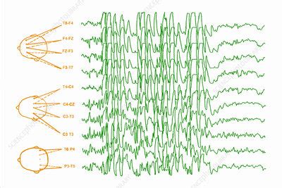 Brain waves in epilepsy - Stock Image - M150/0281 - Science Photo Library