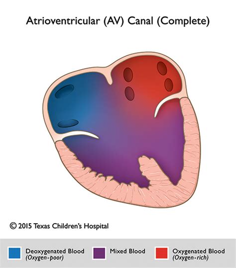 Complete Atrioventricular Canal Av Canal Pediatric Echocardiography | My XXX Hot Girl