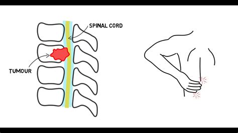 Spinal cord compression - askgulu