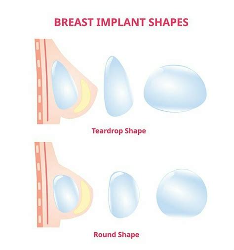 Breast Implant Shapes and Sizes | Boutinic Aesthetics