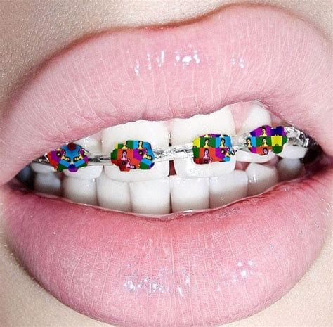 Pin by Virjni _t on pastels | Dental braces, Lip art, Cute braces colors