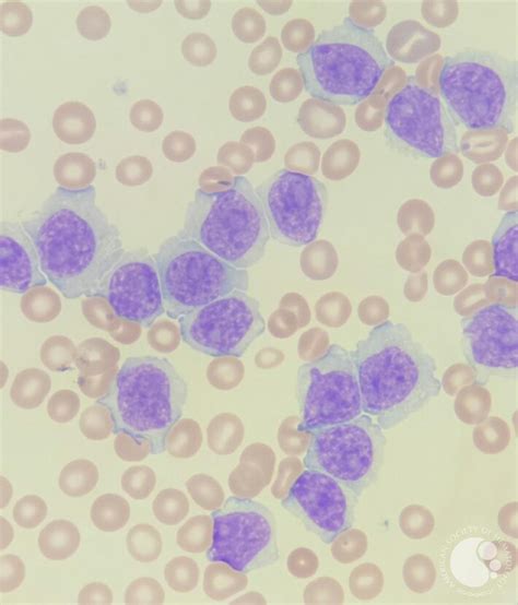 Marginal zone B-cell lymphoma blood smear