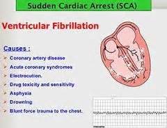 20 best Ventricular Fibrillation images on Pinterest | Nursing schools, Schools for nursing and ...