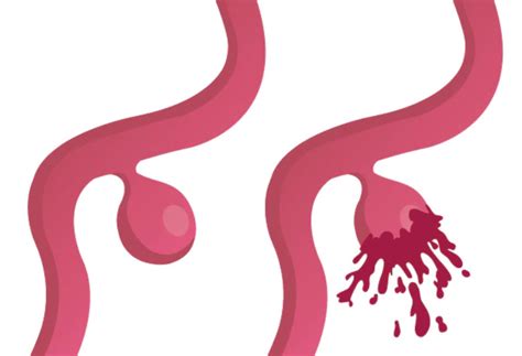 Aneurisma cerebral: causas, síntomas y pronóstico