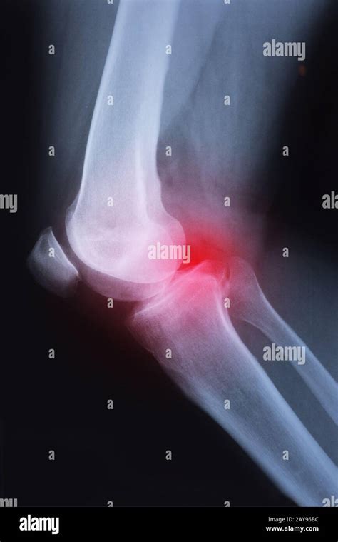 Rheumatoid Arthritis Joint High Resolution Stock Photography and Images - Alamy