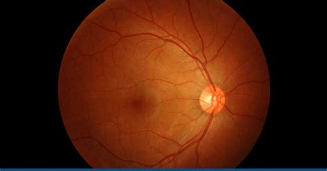 Hypertensive Retinopathy - Symptoms, Diagnosis and Stages