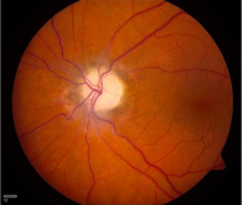 Optic nerve atrophy. Causes, symptoms, treatment Optic nerve atrophy