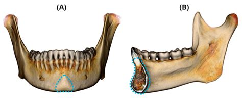 IJERPH | Free Full-Text | Variation in Chin and Mandibular Symphysis Size and Shape in Males and ...