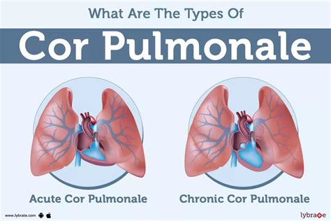 Cor Pulmonale: Causes, Symptoms, Treatment and Cost