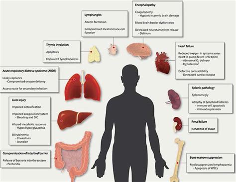 Sepsis Infection: Symptoms, Causes and Risk Involved | OnlyMyHealth