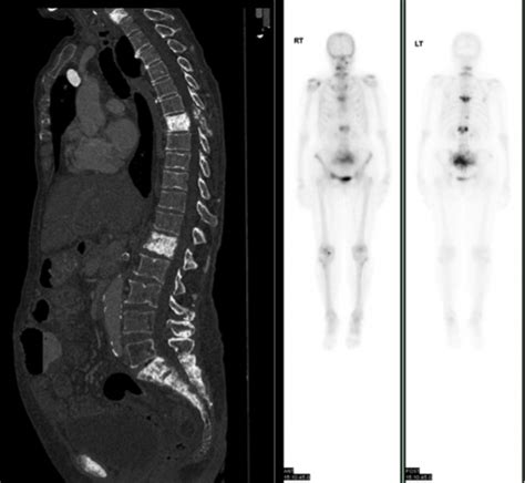 Bone metastases - CT and bone scan - Radiology at St. Vincent's University Hospital