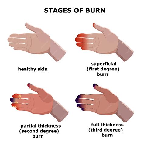 Premium Vector | Medical vector illustration Burn stages Degree burns ...