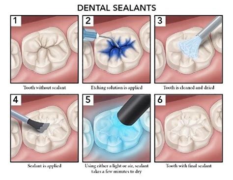 How We Place “Power Shields” at Sweet Tooth – Pediatric Dental Blog in 2024 | Dental sealants ...