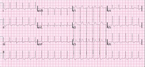 Dr. Smith's ECG Blog: Atrial Flutter Mimicking ST Depression