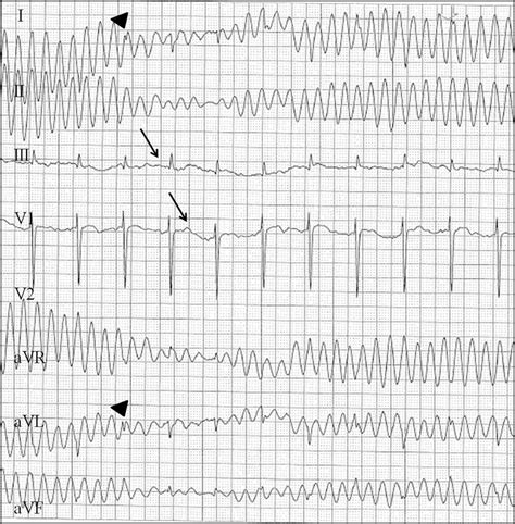 Expanded telemetry strips to include all electrocardiogram leads.... | Download Scientific Diagram