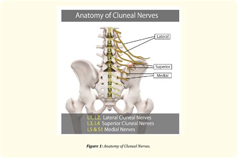 Figure 1 from A Radiofrequency Treatment Pathway for Cluneal Nerve ...