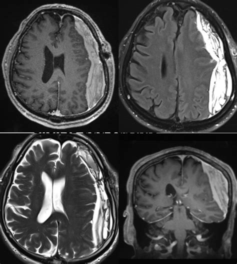 Subdural MMA Embolization Via Collaterals Remote Pterional Craniotomy Follow Up | neuroangio.org