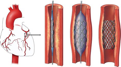 What You Need To Know About A Heart Stent - Central Georgia Heart Center