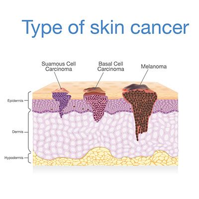 3 Warning Signs Skin Cancer For Early Detection | Vejthani