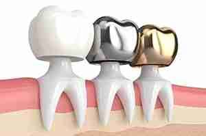 TYPES OF DENTAL CROWNS AND COST: A COMPLETE GUIDE (2022)