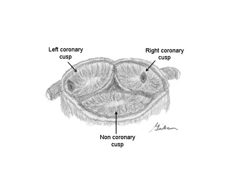 Aortic sinus - wikidoc