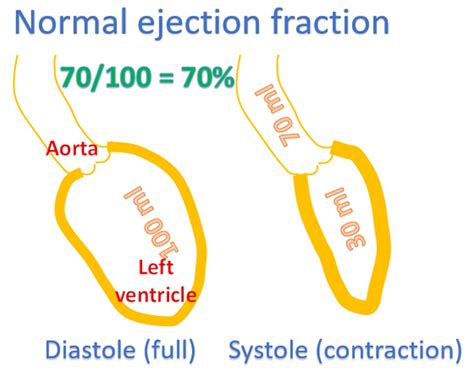 What is heart failure with preserved ejection fraction? - All About Heart And Blood Vessels