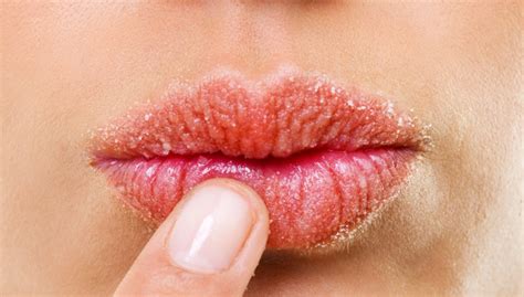 How Do You Treat Itchy Lips Naturally?