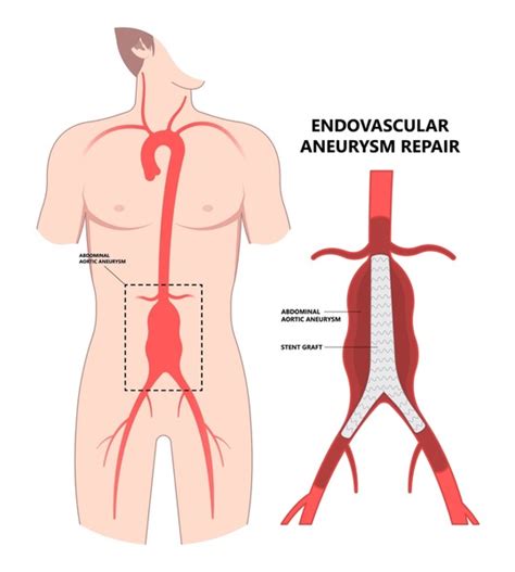 98 Blood Clot Abdomen Royalty-Free Images, Stock Photos & Pictures ...