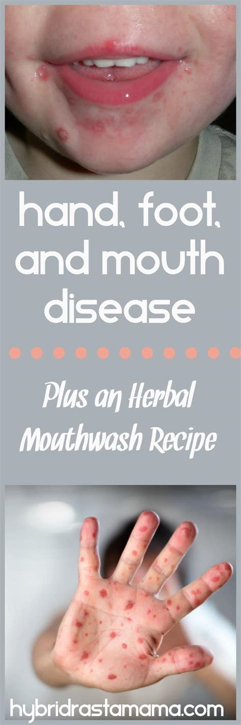 Herbs and Children – Hand, Foot, and Mouth Disease (Plus An Herbal ...