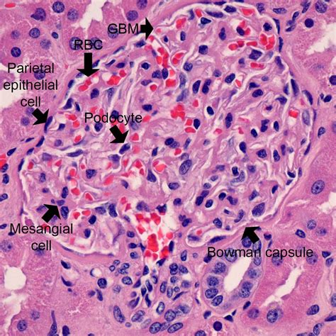 Kidney Biopsy of the Month: What is Normal? - Renal Fellow Network