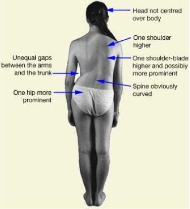 Scoliosis symptoms Archives - Scoliosis Clinic UK - Treating Scoliosis ...