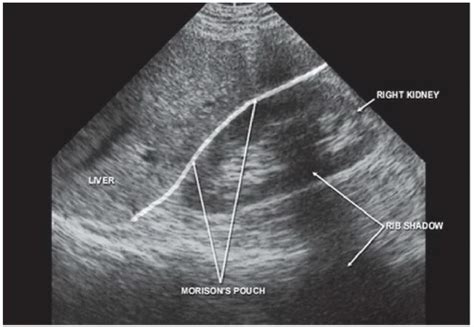 Trauma | Radiology Key