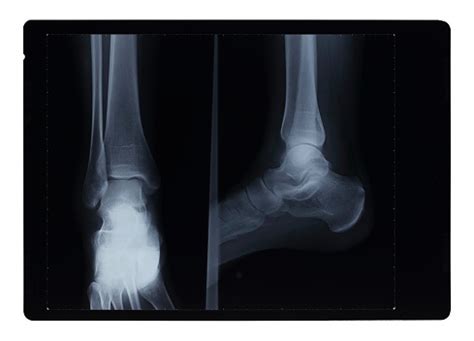 발목 X선 헤어라인 무늬 골절 엑스레이 이미지에 대한 스톡 사진 및 기타 이미지 - 엑스레이 이미지, 검은색, 골절 - iStock