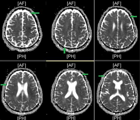 Neurosyphilis Presenting with Anxiety: A Case Report | Cureus