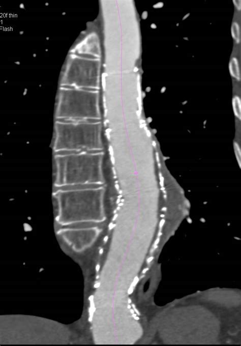 Center Line Tracking of Tortuous Aorta - Vascular Case Studies - CTisus ...