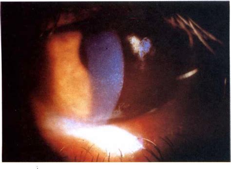 Severe superficial punctate keratitis and punctate epi­ thelial... | Download Scientific Diagram