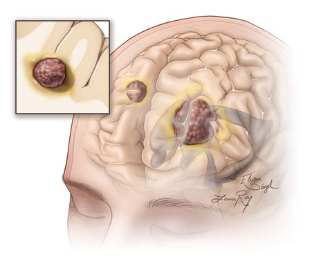 Metastasis | The Neurosurgical Atlas, by Aaron Cohen-Gadol, M.D.