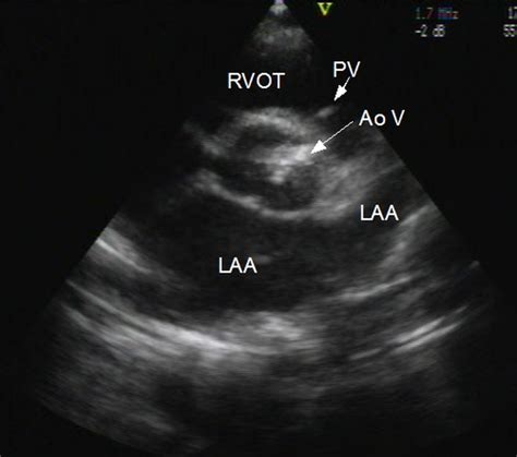 Aortic stenosis: Echocardiogram in parasternal short axis view