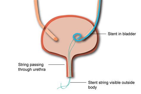 Ureteral Stent